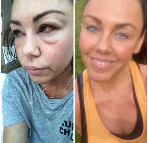 alcohol can literally destroy your face