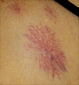 spider angiomas is a sign of liver damage